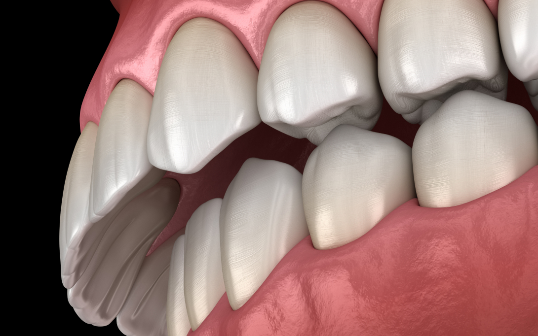 malocclusion overbite 3d rendering